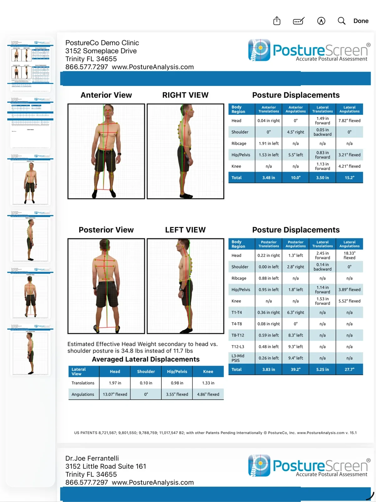PostureScreen client report PDF on iPad: anterior, posterior and both side views with posture displacement tables.