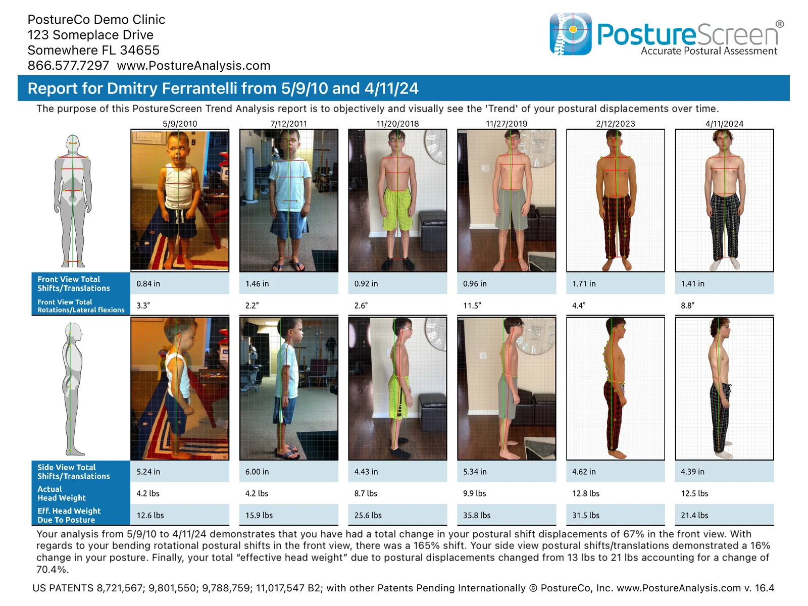 A PostureScreen Posture Trend Analysis report on iPad in landscape: front and side photos of the same client from six exams, 2010 to 2024, with front and side shifts, rotations, actual and effective head weight under each, and a summary of the change.
