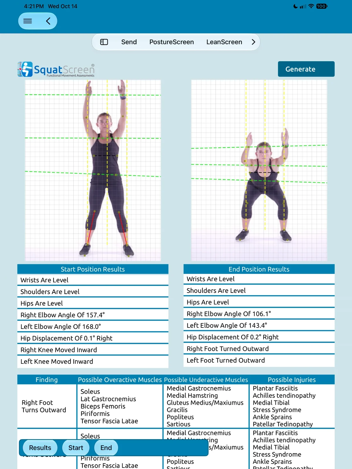 SquatScreen AP overhead squat results on iPad: start and end photos from the front on a grid with landmark points and lines, start and end position results such as elbow angles, hip displacement and knees moved inward, and a findings table for right foot turns outward with possible overactive and underactive muscles.