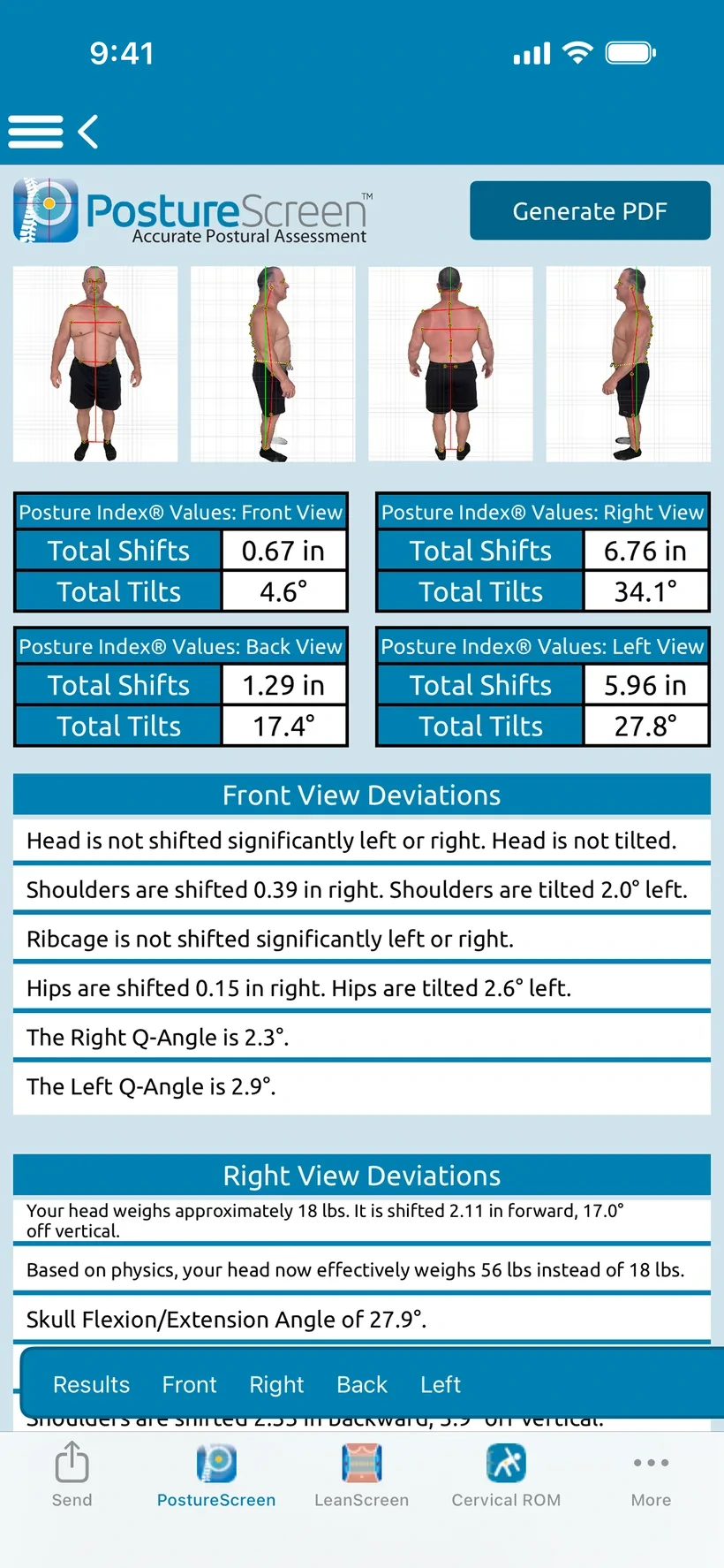 PostureScreen posture results on iPhone.