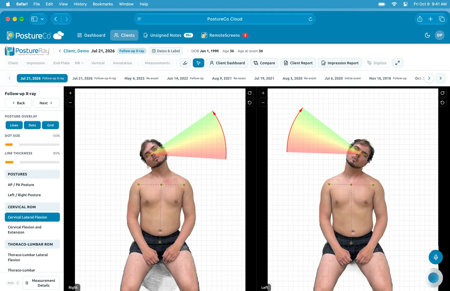 Preview: a demo client’s cervical lateral flexion, right and left photos side by side with range-of-motion overlays, on an iMac.