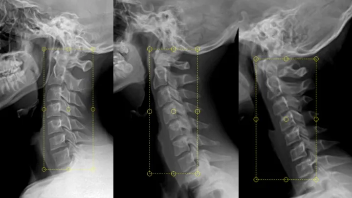 Three lateral cervical X-rays, each with the region found by PostureRay computer vision marked by a dashed box.