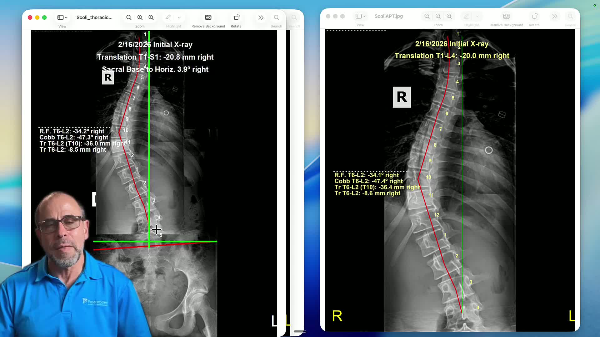 Stitching Considerations especially for Scoliosis Cases - PostureScreen ...